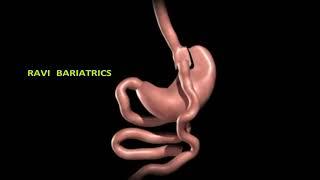 GASTRIC BYPASS SURGERY PROCEDURE EXPLAINED BY Dr RAVIKANTH KONGARA HYDERABAD VIJAYAWADA