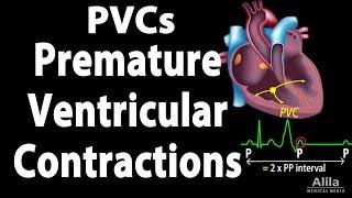 Premature Ventricular Contractions (PVCs), Animation