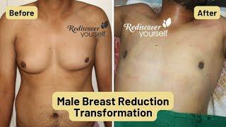 Unveiling the Secret to Eliminate Male Breasts Forever: Gynecomastia Surgery at Chrysalis