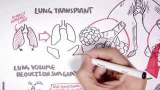 Emphysema Treatment