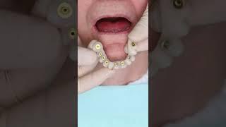 Dental implant’s All on 4 in Prague #shorts #dentist #dental #implant #veneers #short