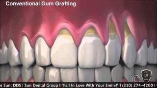 No Cutting Gum Graft with Pinhole Surgical Procedure