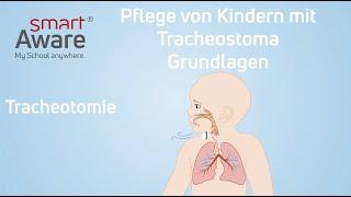 Pflege von Kindern mit Tracheostoma: Tracheotomie | Pflegestandards Kinderkrankenpflege | smartAware