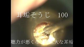 耳垢そうじ/聞こえが悪くなった巨大な耳垢/100