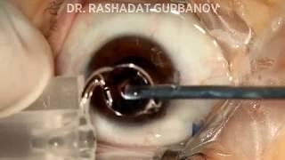 Phacoemulsification Cataract Surgery - Oftalmoloq Dr. Rashadat Gurbanov (2018 Baku)