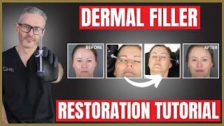 Dermal Filler Demonstration & Tutorial | Liquid Rhinoplasty | Nasolabial Folds