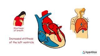 Hypertrophic cardiomyopathy - When the heart muscle becomes abnormally thick