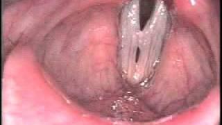 Stroboscopy: Variety of vocal cord polyps