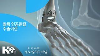 발목 인공관절 수술이란 - (20190306_685회 방송) 내 몸의 균형추, 발 건강을 사수하라