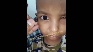 Artificial eye fitting in children #retinoblastoma#artificialeye #fakeeye #duplicate_eye  #eyeimplnt