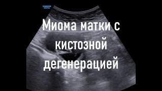 Миома матки с кистозной дегенерацией