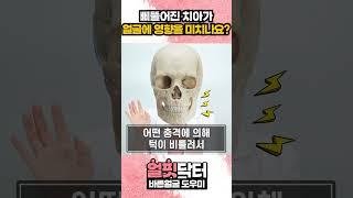 치아 때문에 안면비대칭이 올 수 있나요? #안면비대칭 #shorts #shortsvideo #shortvideo #유튜버 #쇼츠 #이슈 #beauty #뷰티