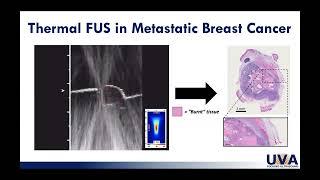 Webinar: Focused Ultrasound and Breast Cancer (2023)