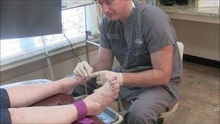 Ingrown Toenail Removal After Care Instructions