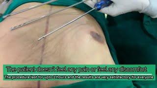 WHAT SIZE OF CANNULA SHOULD A SURGEON USE TO PROVIDE THE BEST RESULTS FOR LIPOSUCTION