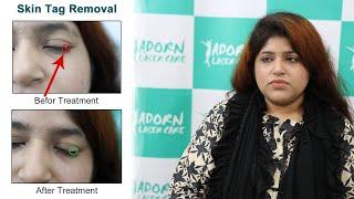 Skin Tag Removal Treatment at Adorn Laser Care | স্কিন ট্যাগ