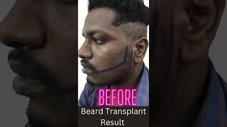 Beard Transplant Result #beardtransplant #hairtransplant #dermatologist #bestskincare #beard