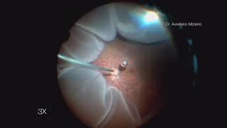 Superior Retinal Detachment that is not involving the Macula | Vitrectomy | Tijuana, Mexico