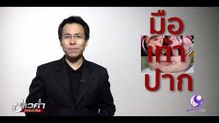 ชัวร์ก่อนแชร์ : โรคมือเท้าปาก ไม่อันตราย จริงหรือ ?
