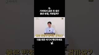 가려워서 긁은 뒤 생긴 붉은 반점, 자반일까? #자반증