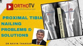 Proximal Tibia Nailing Problems & Solutions : Dr Navin Thakkar