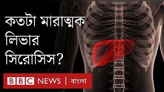 Liver Cirrhosis: লিভার সিরোসিস রোগের কারণ, লক্ষণ ও চিকিৎসা কী?  | BBC Bangla