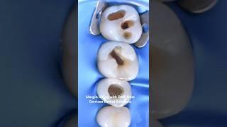 Margin lifting with DME from Garrison Dental Solutions
