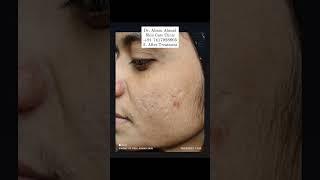 Acne (Pimples) Treatment  By Dr. Ahsan Ahmad WhatsApp No. +91 7417928805