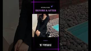팔 지방흡입 #지방흡입후기