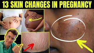 Doctor explains 13 SKIN SIGNS AND CHANGES SEEN IN PREGNANCY (plus real life clinical photos)