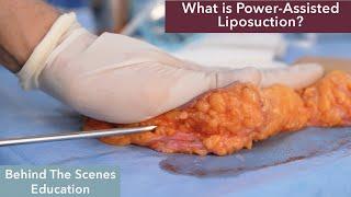 What is Power-Assisted Liposuction (PAL)?