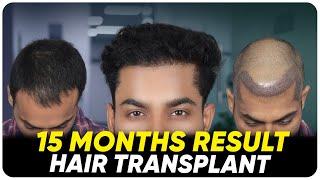 Hair Transplant in Vizag | Best Results & Cost of Hair Transplant in Vizag