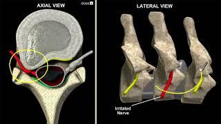 Cox Decompression for neck pain