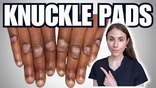 Knuckle Pads: Causes & Treatments Explained