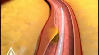 Arterial Stenting - 3D Medical Animation