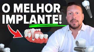 Descubra a melhor MARCA de IMPLANTE DENTÁRIO