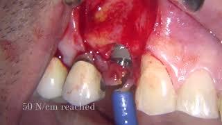 Straumann BLX and Botiss biomaterials in premolar fresh immediate mplant