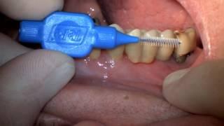 Prosthodontics Video: Implant Oral Hygiene Instruction