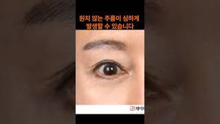 눈처짐에 눈매교정을 하면 생기는일 - 제이제이성형외과#shorts