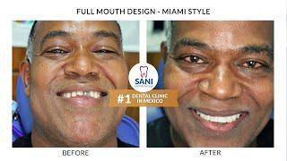 Follow our Patient's Journey-Full Mouth Makeover Cancun