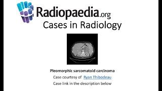 Pleomorphic sarcomatoid carcinoma (Radiopaedia.org) Cases in Radiology