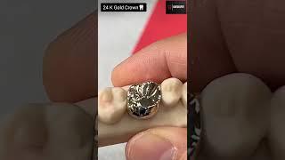 24 Karat Gold Crown | Golden tooth capping #shorts #dentist #viral ‍