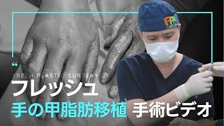 【老化改善】30歳も若く見えるフレッシュ自慢の「手の甲脂肪移植」の手術動画を大公開します　#若返り ＃童顔　＃韓国整形