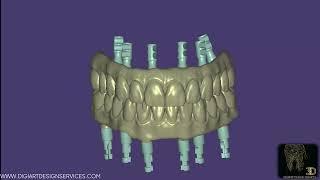 Exocad : Custom Implant Bridge