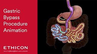 Gastric Bypass Procedure Animation