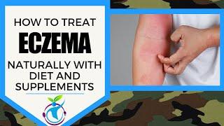 ECZEMA - How To Treat It Naturally With Diet & Supplements