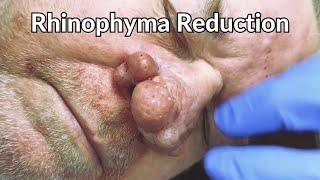 MAJOR Rhinophyma Reduction | CONTOUR DERMATOLOGY