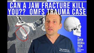 CAN a JAW FRACTURE KILL YOU?? OMFS TRAUMA CASE