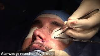 Alar Wedge Resection-50/990:Rhinoplasty Bizrah- London/ Dubai-Dr Bashar Bizrah