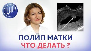 Полип эндометрия - удалять или не удалять? Отвечает врач акушер-гинеколог ЦИР, Дементьева С.Н.